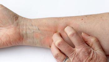 Prurito alla pelle arrossata - Una donna si gratta il braccio
