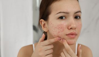 Menina adolescente com problemas de acne a espremer borbulha dentro de casa