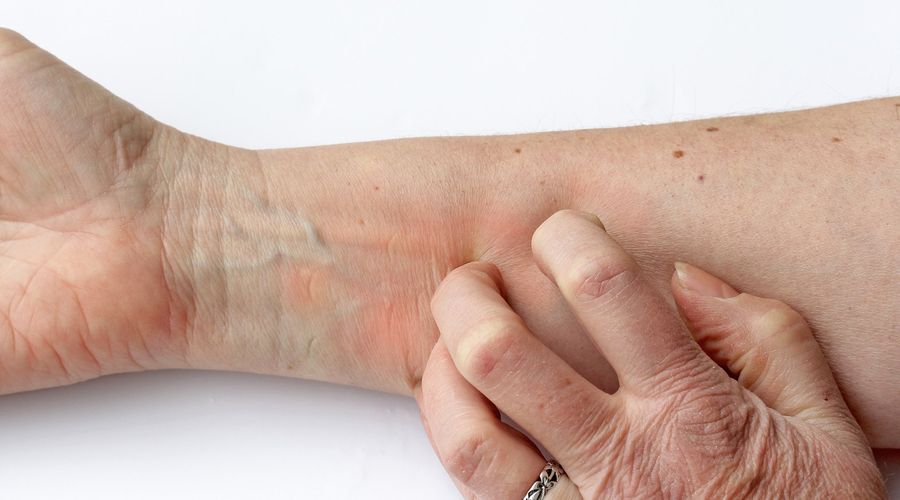 Itching reddened skin - A woman scratches her arm