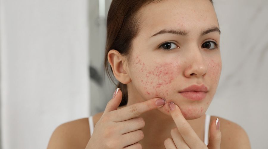 Teen girl with acne problem squeezing pimple indoors 