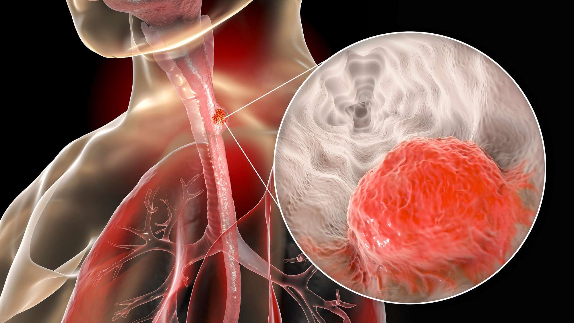 3D Illustrierung einer Speiseröhre als Röntgen mit einer Detailansicht eines Tumors.