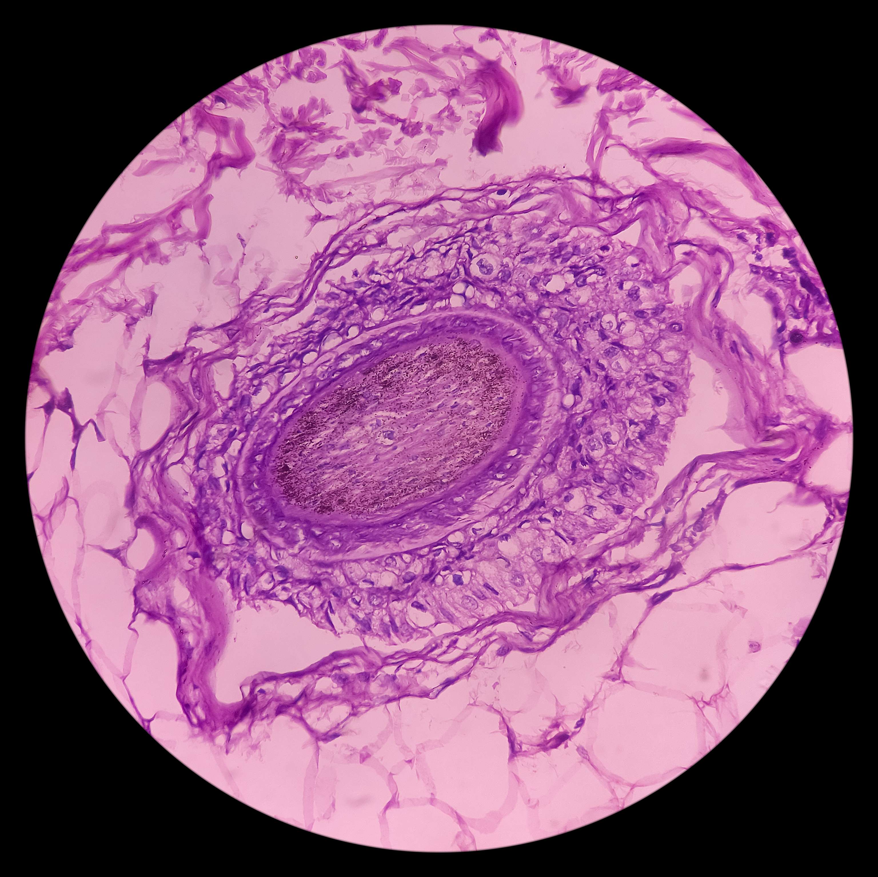 Biopsie d'un carcinome basocellulaire