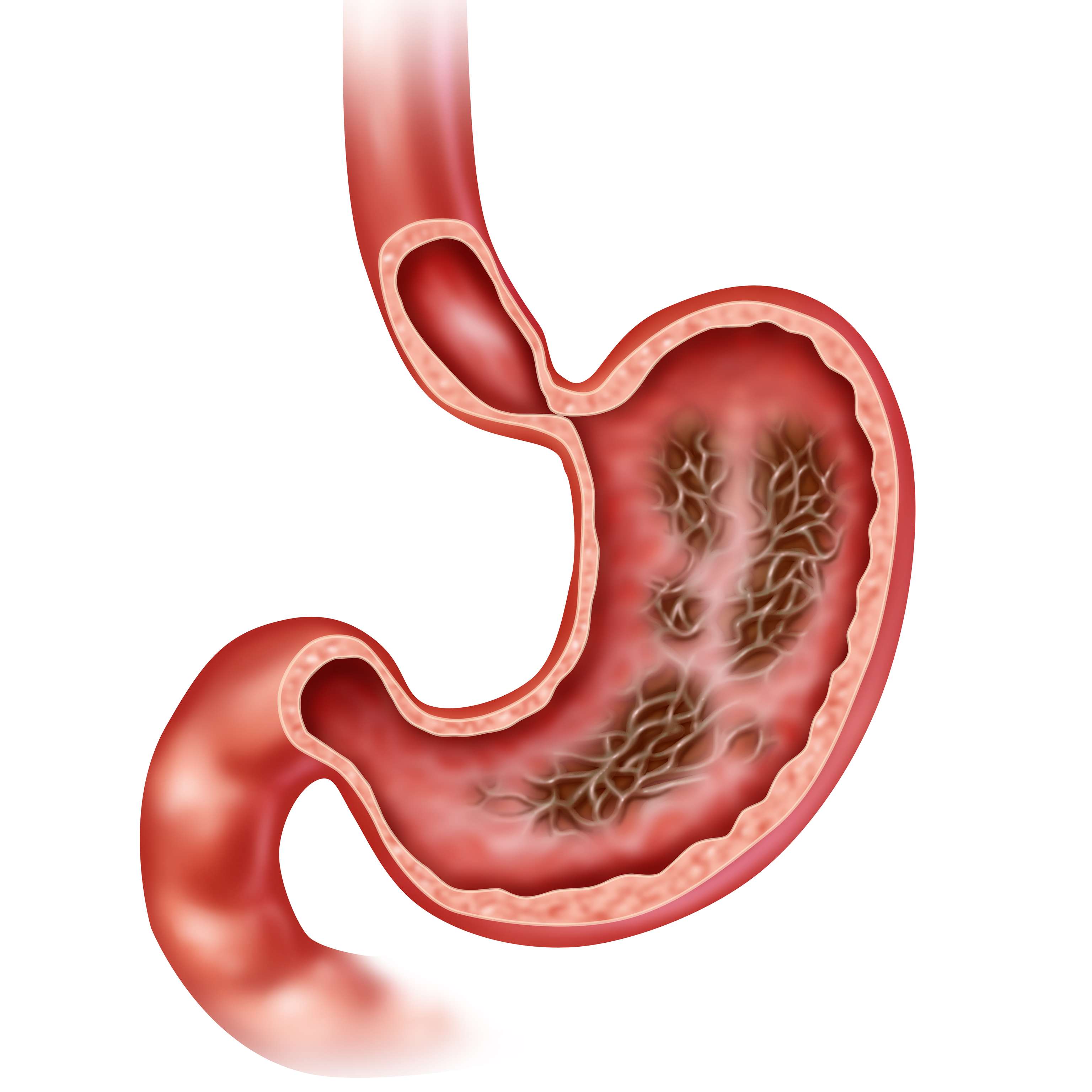 Illustration of the stomach with gastritis