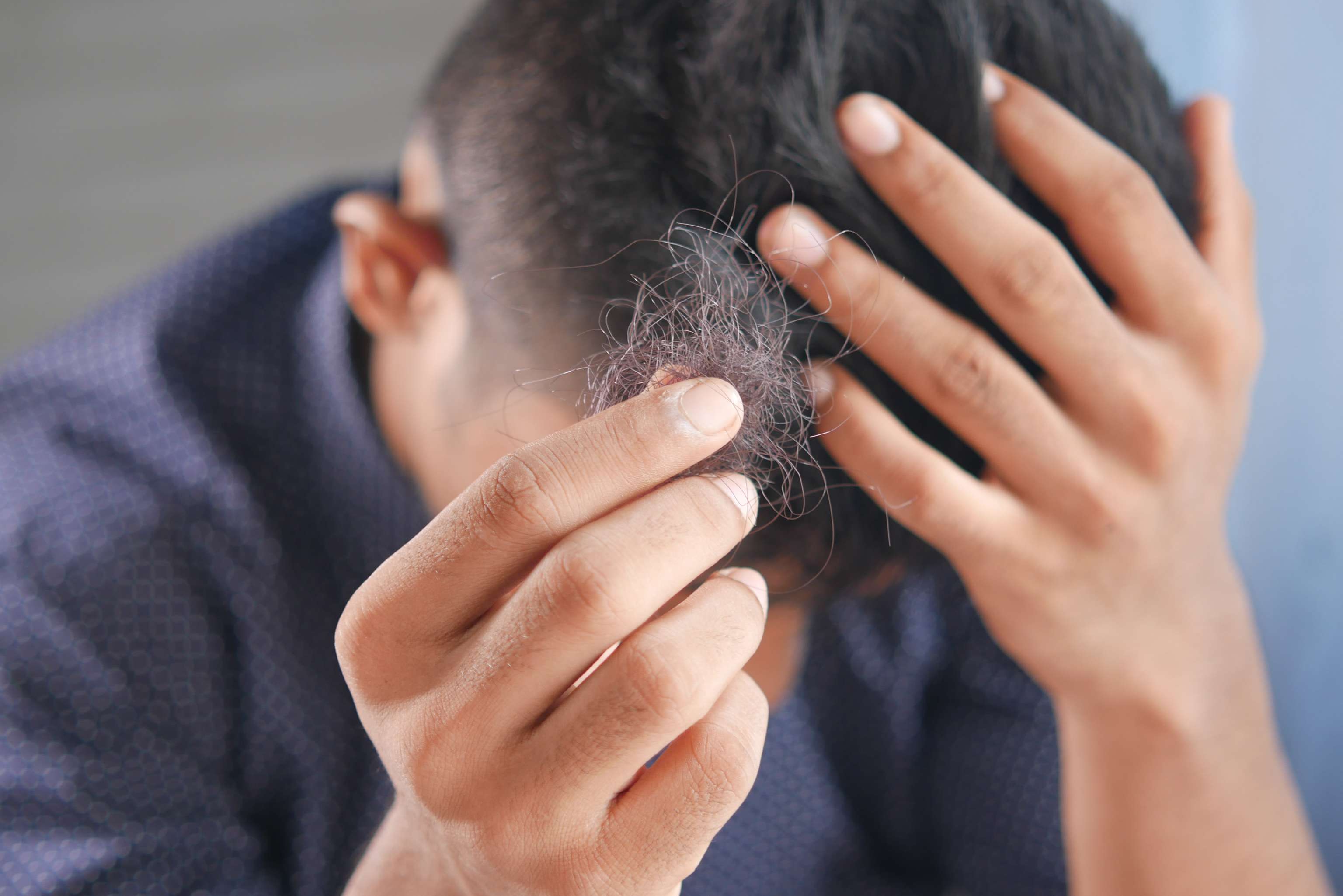 Welche Rolle Dihydrotestosteron beim Haarausfall spielt
