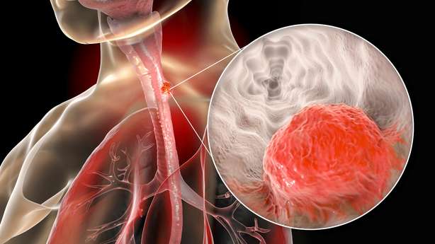Esophageal cancer, 3D illustration showing malignant tumor in the human esophagus 3D Illustrierung einer Speiseröhre als Röntgen mit einer Detailansicht eines Tumors.
