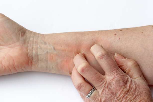 Eine Frau kratzt sich am Arm Itching reddened skin - A woman scratches her arm