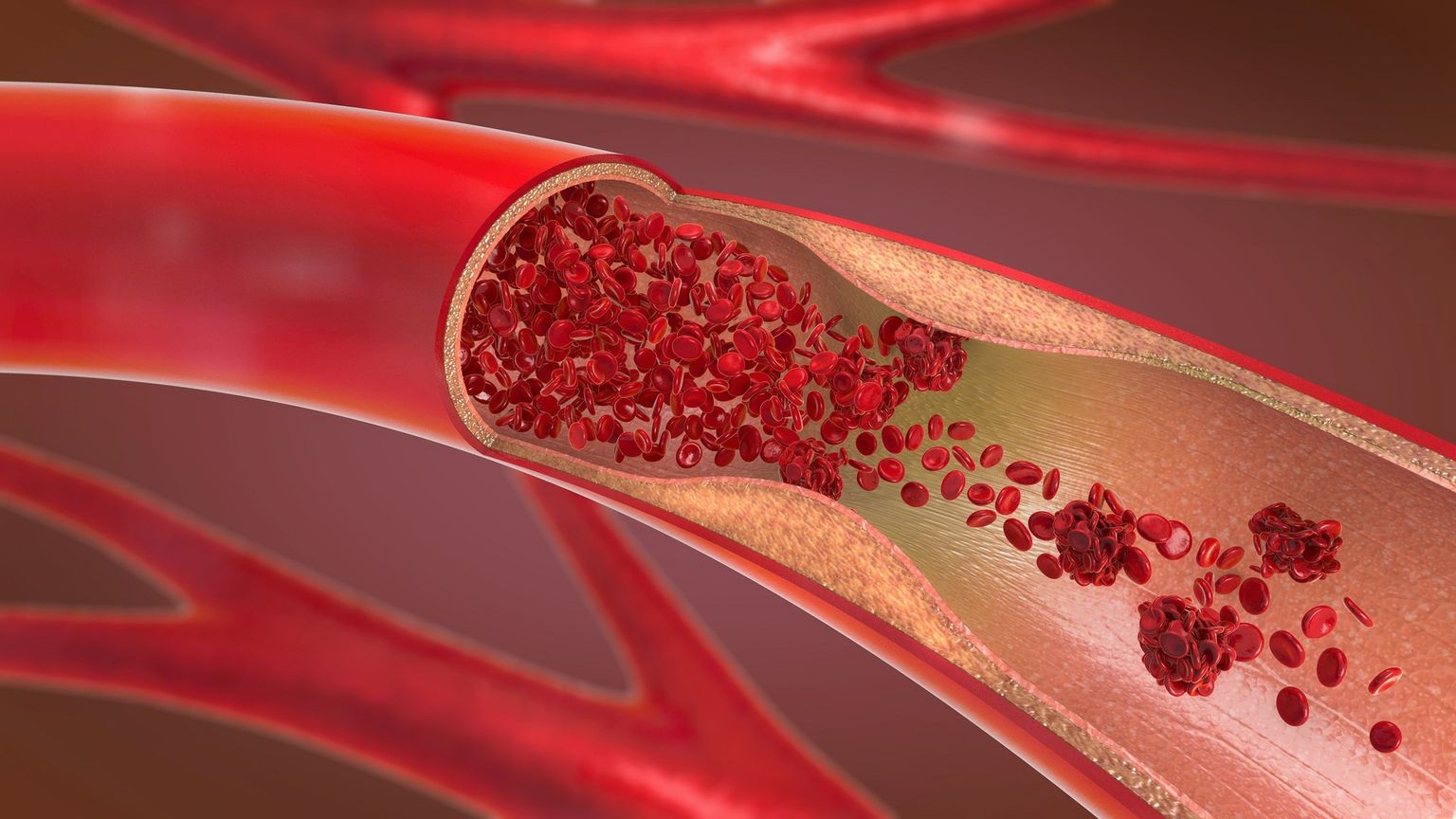 Arteriosclerosis - Arteriosclerosis means that the blood can no longer flow properly. 