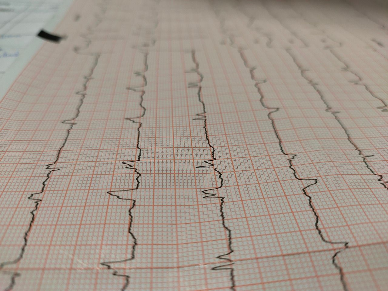 ECG infarto de miocardio